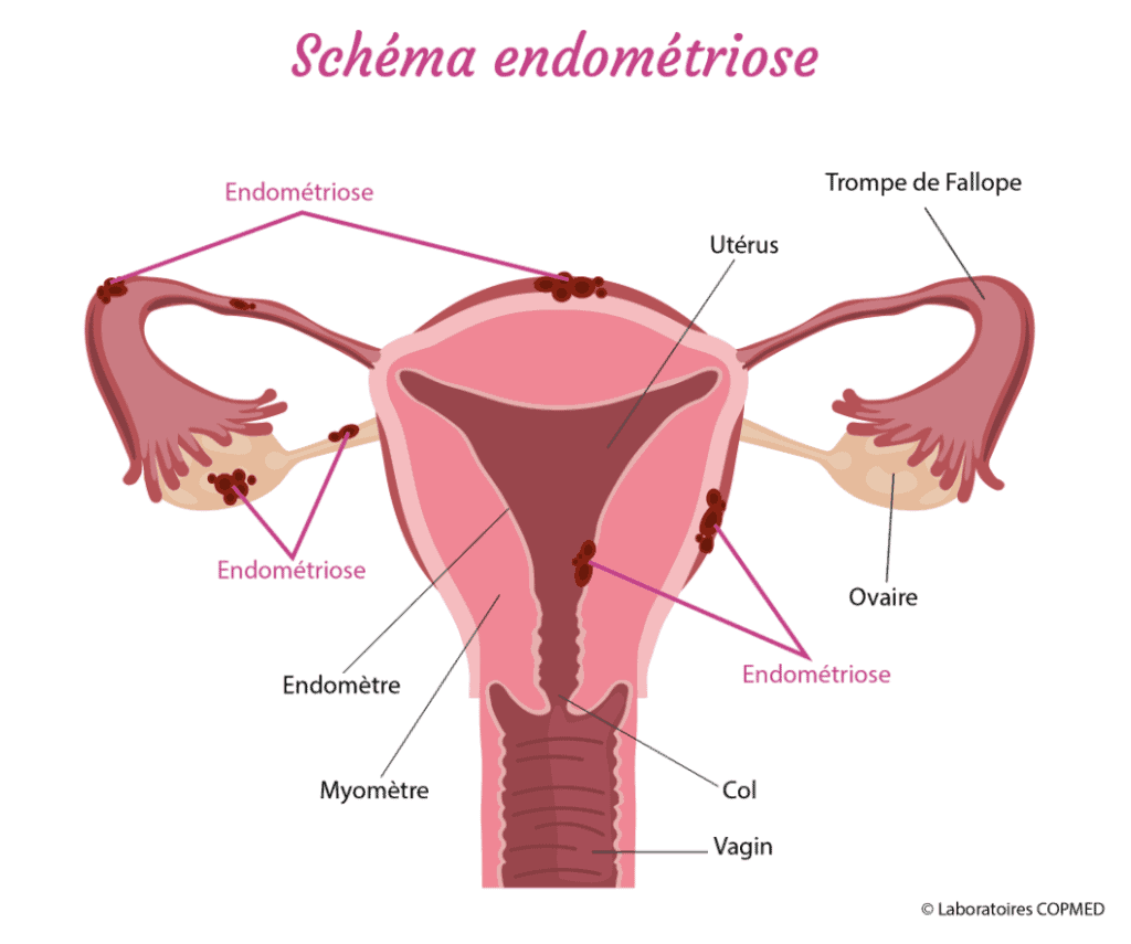 endométriose