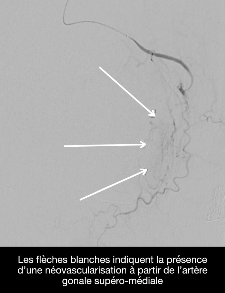 embolisation, schéma 1, CHL