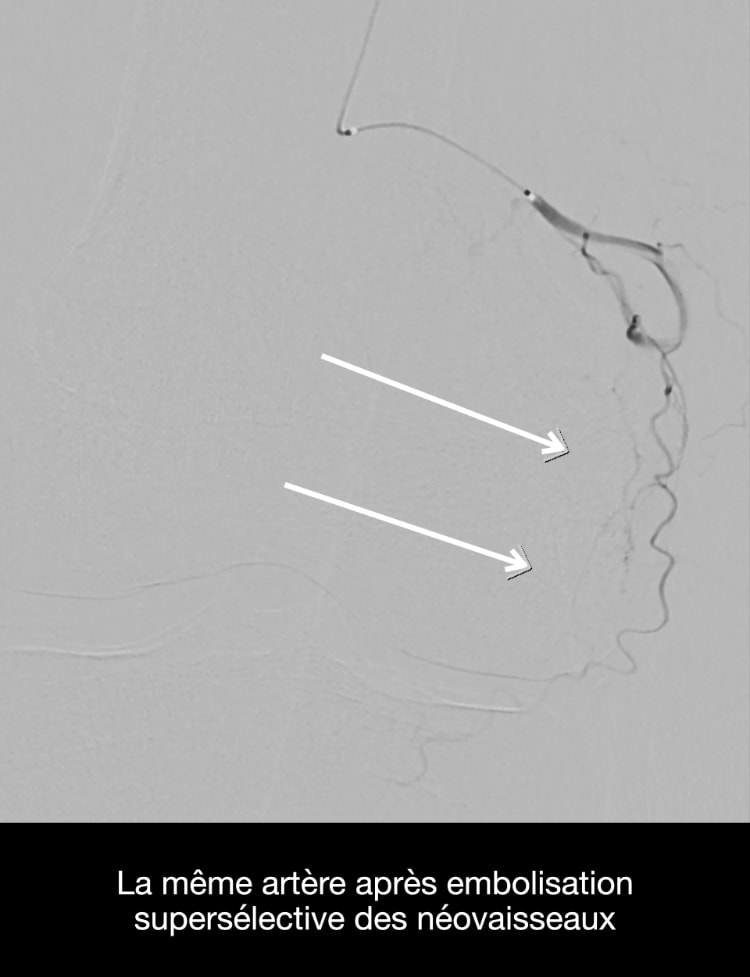 embolisation, schéma 2 post op, CHL