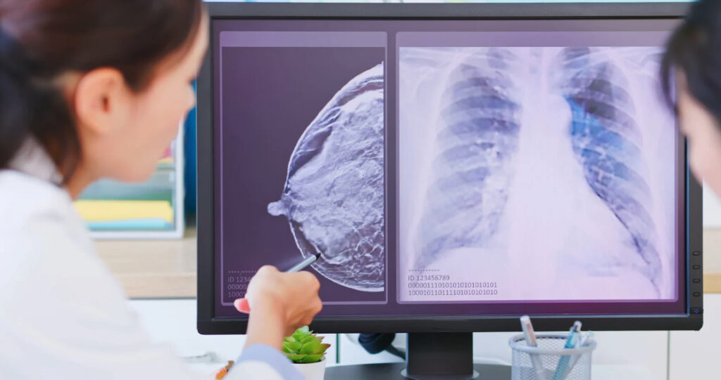 cancer du sein, importance du dépistage
