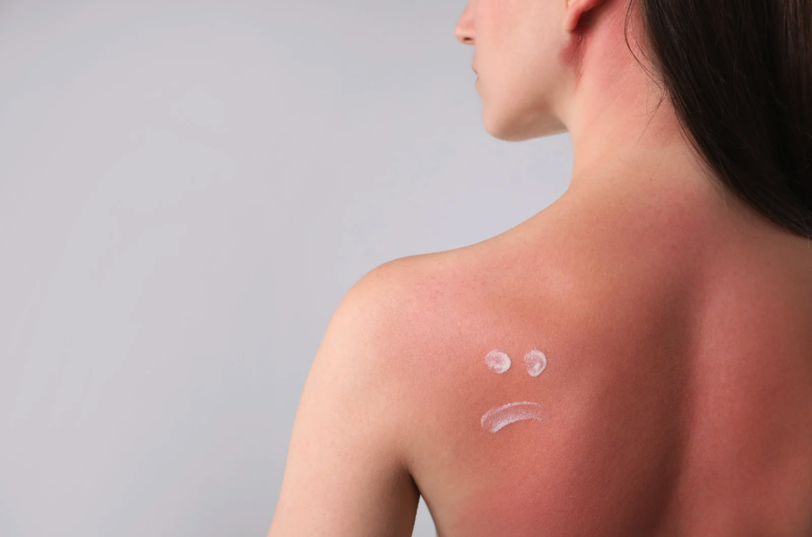 cancer de la peau, coups de soleil à éviter absolument 
