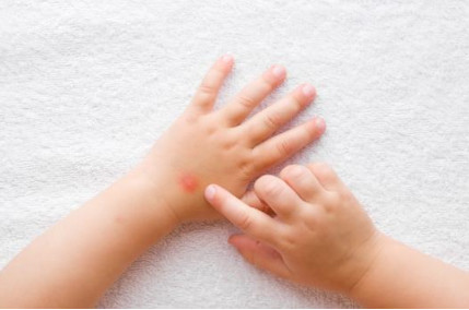 solutions de santé, solutions de santé pour les piqûres de moustiques
