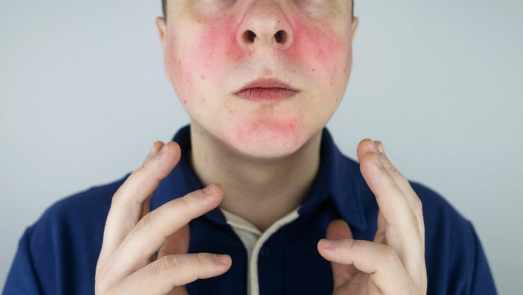 rosacée, rosacée développée, visage d'un homme atteint de rosacée, jeune homme avec polo bleu